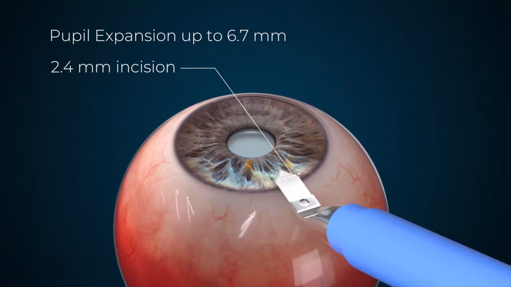 A-Flex-Eye-Pupil-Expander-Surgery-3D-Video