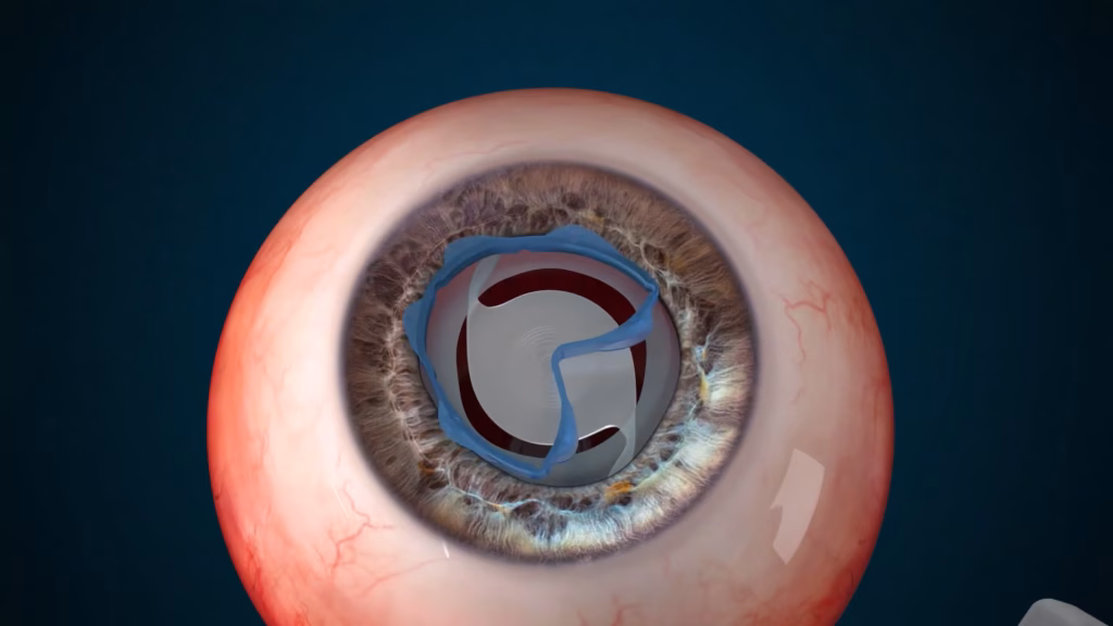 Eye-Pupil-Expander-Surgery-3D-Video